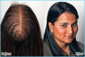  Custom Thinning Hair Solutions